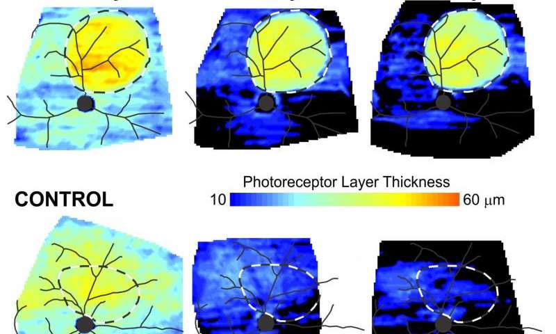 Retinitis_Pigmentosa_Study_University_of_Pennsylvania